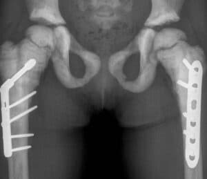 Osteopetrosis ADO2 radiopaedia case ID 8037