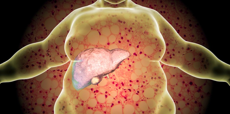 liver disease nash promethera