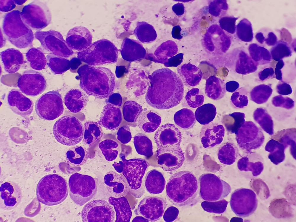 Acute myeloid leukemia leukaemia