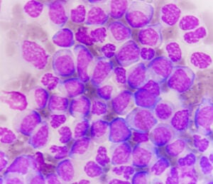 acute myeloid leukemia AML leukaemia
